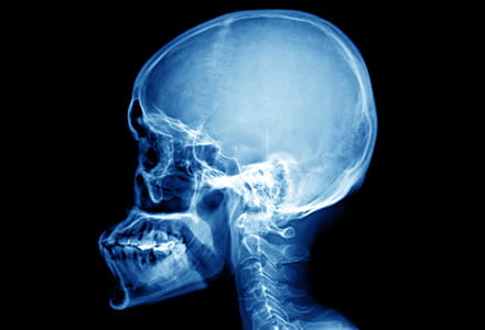 xray of skull
